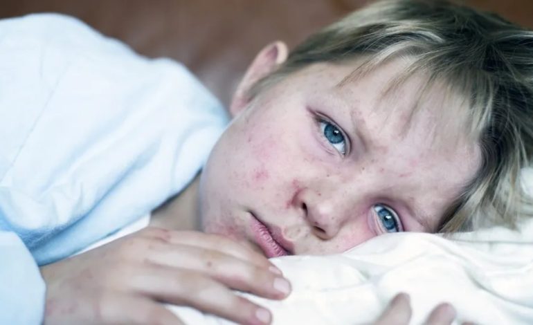 OBSH në alarm! Rriten me 30-fish infektimet me fruth në Evropë: Shumë pacientë…