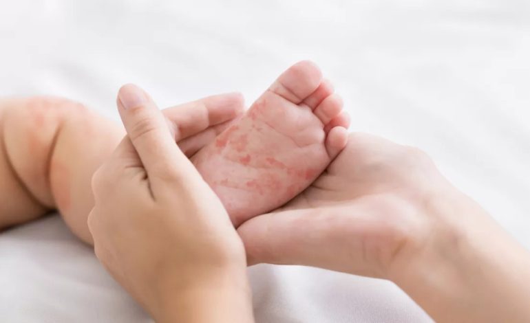 OBSH në alarm! Rriten me 30-fish infektimet me fruth në Evropë