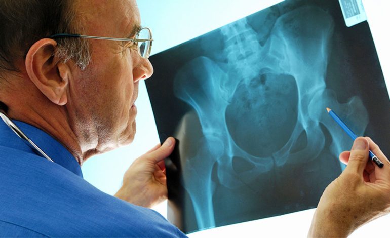 Gjashtë Shenjat Paralajmëruese të Osteoporozës – Si ta Shmangni