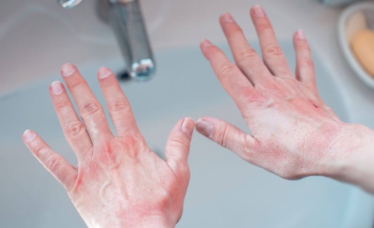 Çfarë Tregojnë Duart e Skuqura për Shëndetin Tuaj – Mënyrat për të Lehtësuar Gjendjen