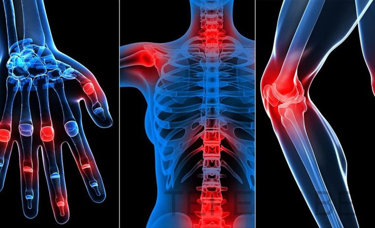 Artriti dhe Artralgia – Sëmundjet që Dëmtojnë Kyçet dhe Nyjat