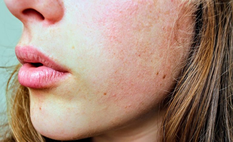 Cilat Janë Vitaminat e Duhura për të Luftuar Lëkurën e Thatë?