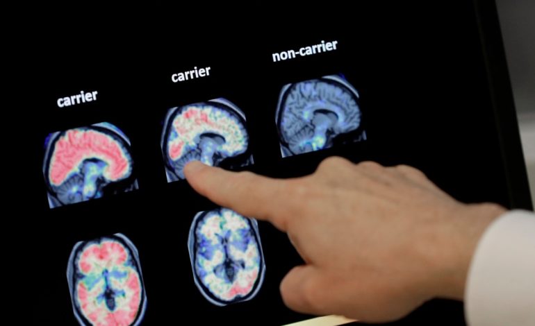 Hulumtimi, testi i gjakut mund të përcaktojë diagnozën me Alcajmer 