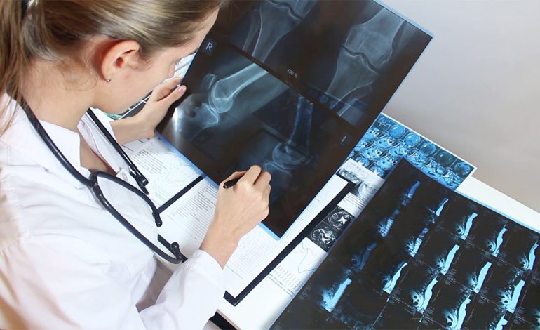 Tri Shenjat Paralajmëruese të Osteoporozës që Duhet t’i Dini Patjetër