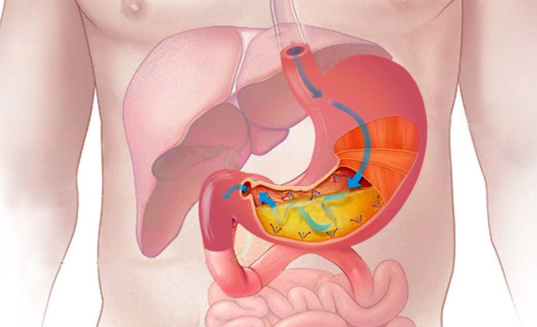 Një Simptomë e Shëndetit të Keq të Stomakut – Kujdesi që Duhet të Tregoni
