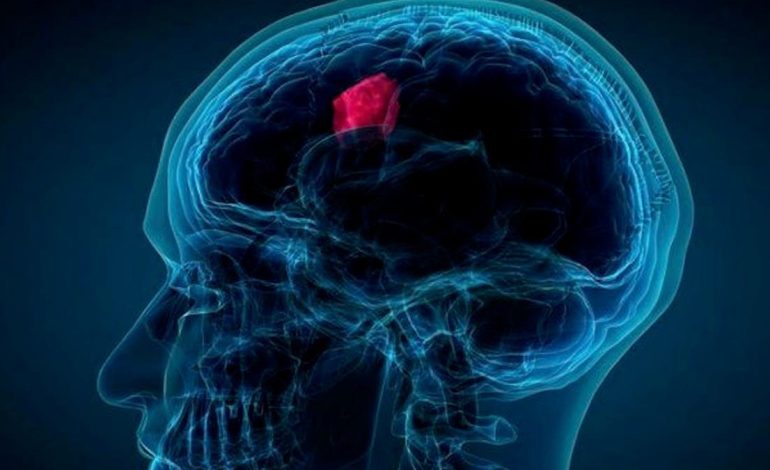 Çfarë Tregon Testi i Parë Për Zbulimin e Turmorit Në Tru – Zbulojeni Këtu