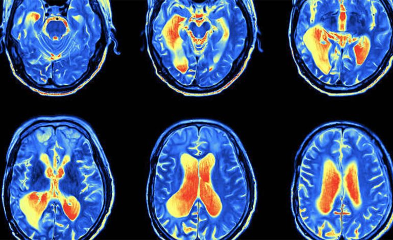 Si Ndikon Kolesteroli i Lartë tek Plakja e Trurit – Çfarë Duhet të Bëni