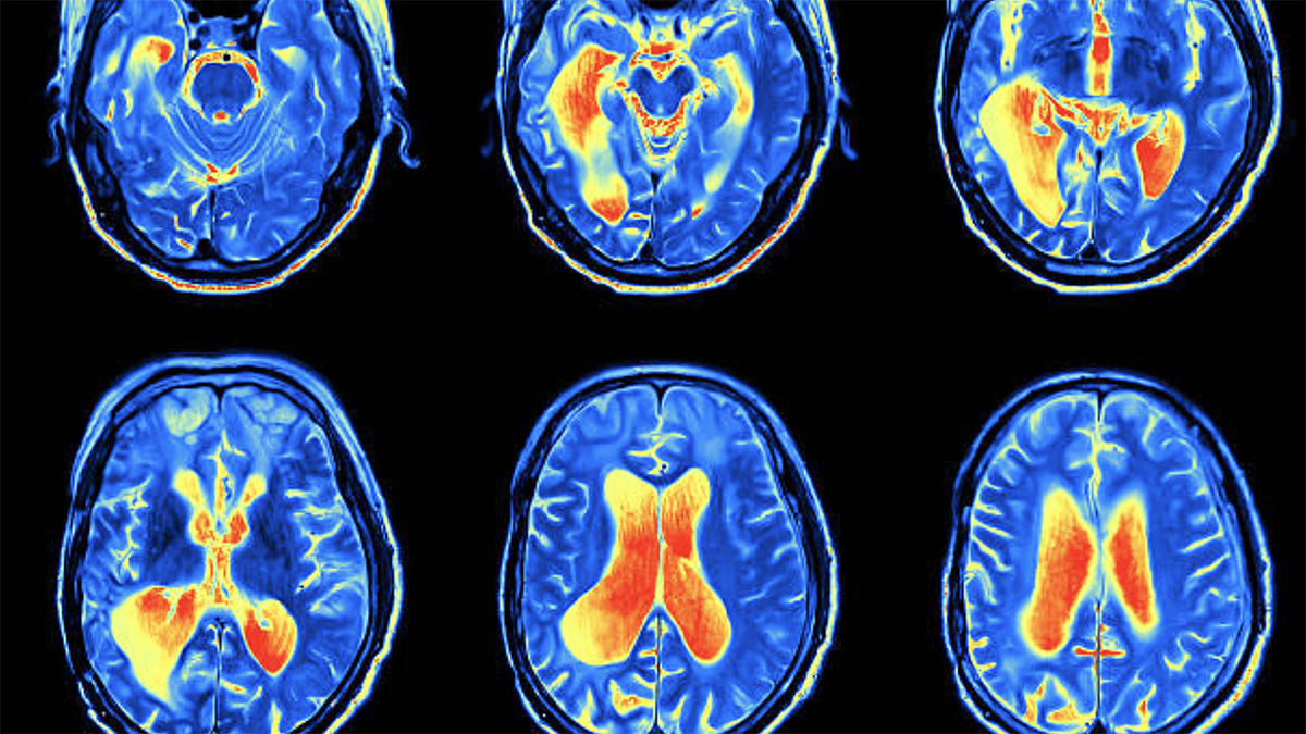 Si Ndikon Kolesteroli i Lartë tek Plakja e Trurit – Çfarë Duhet të Bëni
