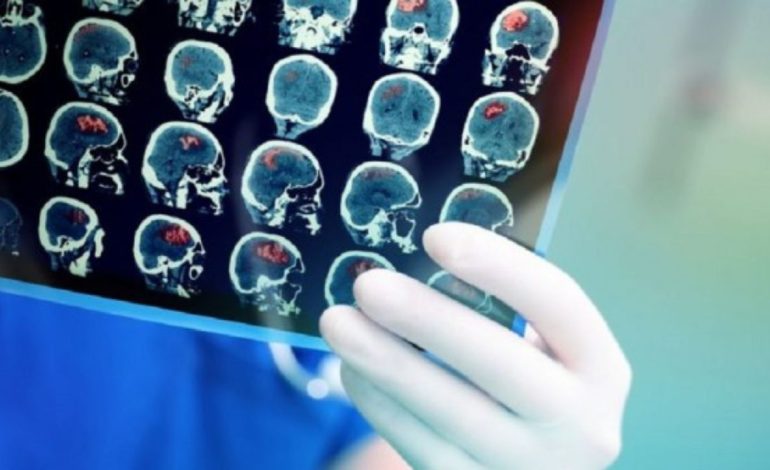 ​Studimi: Çrregullimet e sistemit nervor, shkaku kryesor i sëmundjeve në botë