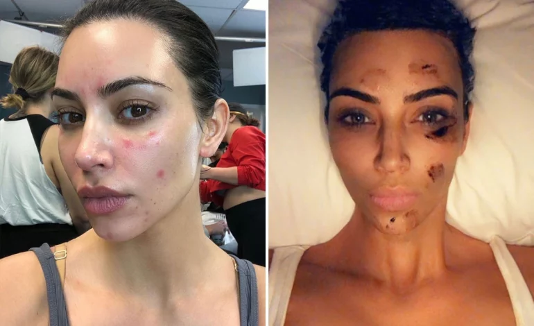 I dinit?! Këto janë 5 shkaqet e shpërthimit të akneve