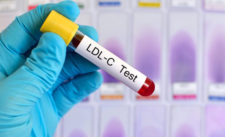 5 Faktorë që Ndikojnë në Testet e Kolesterolit