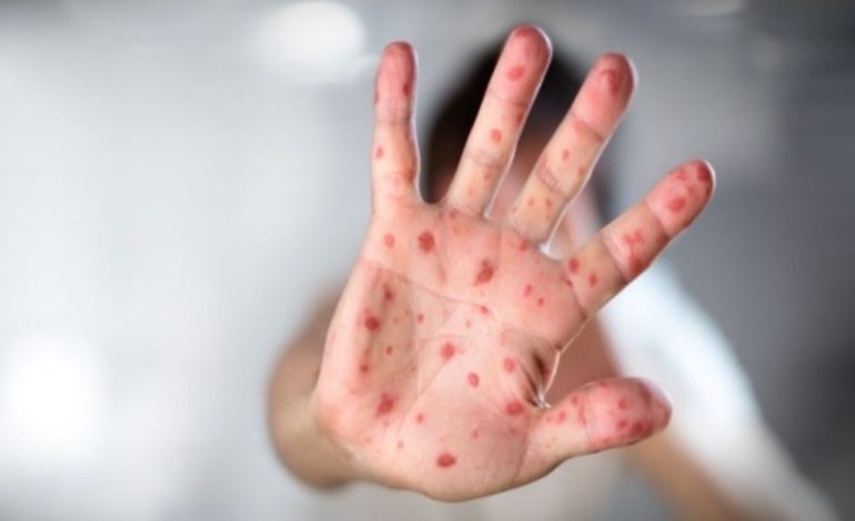 Dyfishohen rastet e fruthit brenda një viti në mbarë botën, incidenca më e lartë në Azerbajxhan, Kirgistan dhe Jemen