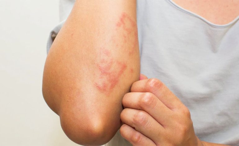 Rastet kur Lëkura Paralajmëron Sëmundje