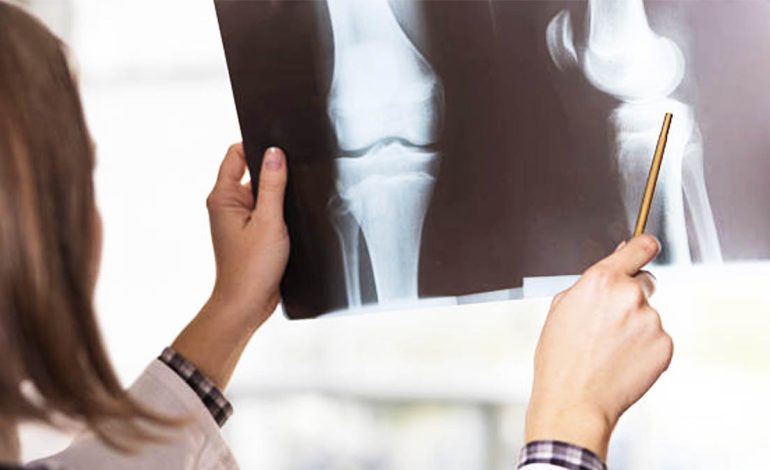 Lista me Ushqimet që Dëmtojnë Shëndetin e Kockave