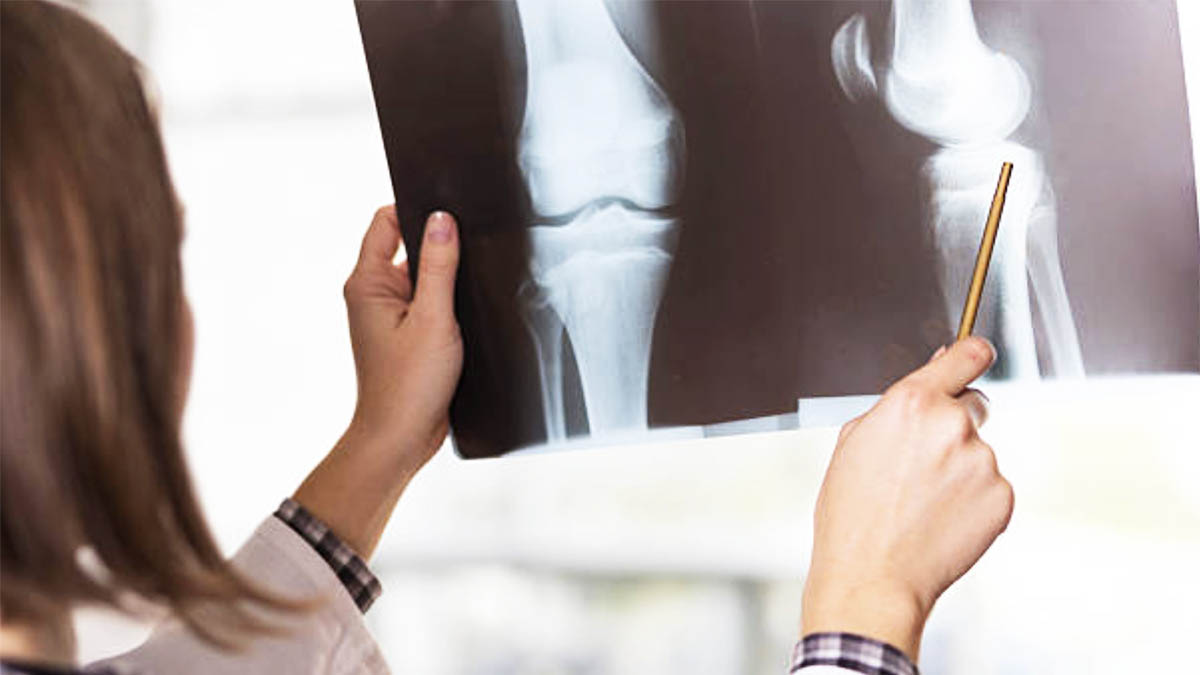 Lista me Ushqimet që Dëmtojnë Shëndetin e Kockave