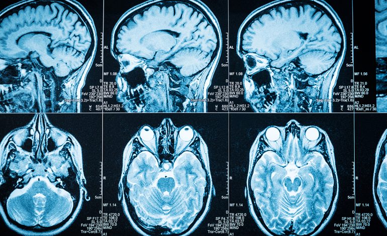 Të Vërtetat e Miteve më të Përhapura Rreth Epilepsisë