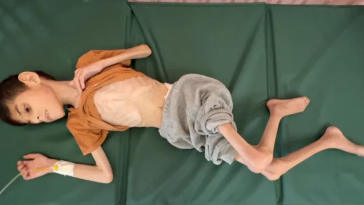 Pamje tronditëse! Fëmijët e gjymtuar nuk flasin dhe lëvizin dot, ndodhen afër vdekjes! Shkak kontaminimi i ujit dhe kequshqyerja në Gaza