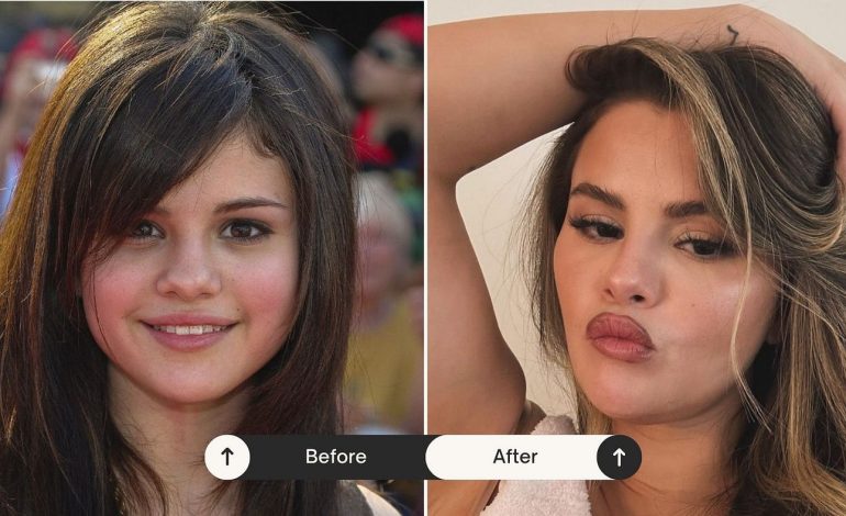 Si ishte si është! Selena Gomez pranon për herë të parë ndërhyrjet estetike
