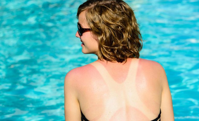 Kremi Mbrojtës apo Nxirës? Si të Kujdeseni për Lëkurën në Plazh