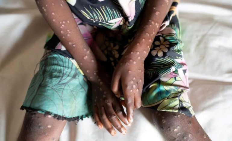 Lija e majmunëve, emergjencë globale/ Çfarë është mpox, si përhapet dhe si mund të kurohet