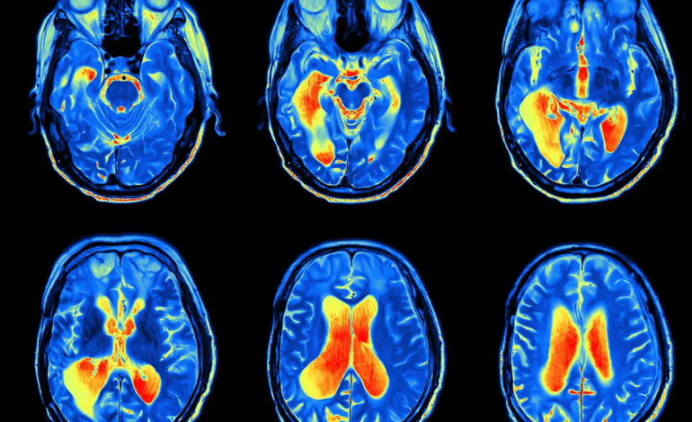 Vrapi Zgjidhja për Shëndetin e Trurit dhe Humorin