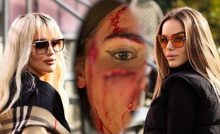 “Dëmtime të rënda, të përhershme”/ Motrat Berisha dhunuan Klea Prengën, del ekzaminimi: Mpirje të anës së djathtë të fytyrës dhe të buzës