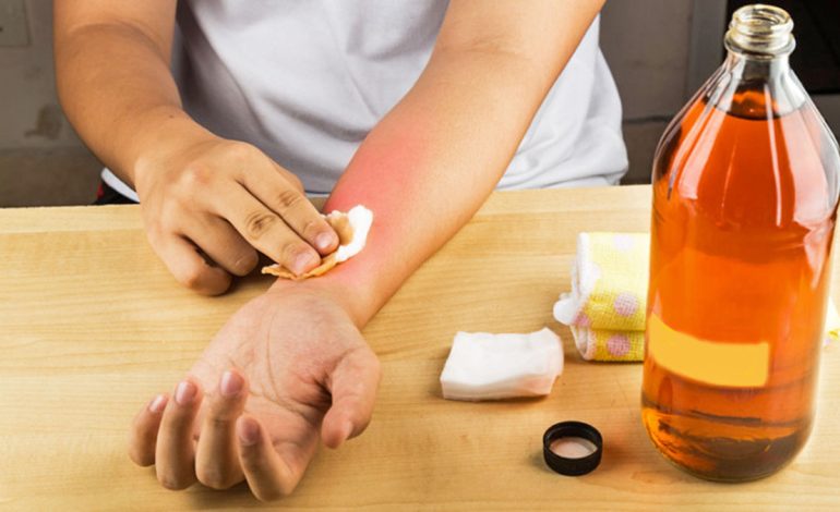 Pezmatimi i Lëkurës – Kurat më të Mira Natyrale